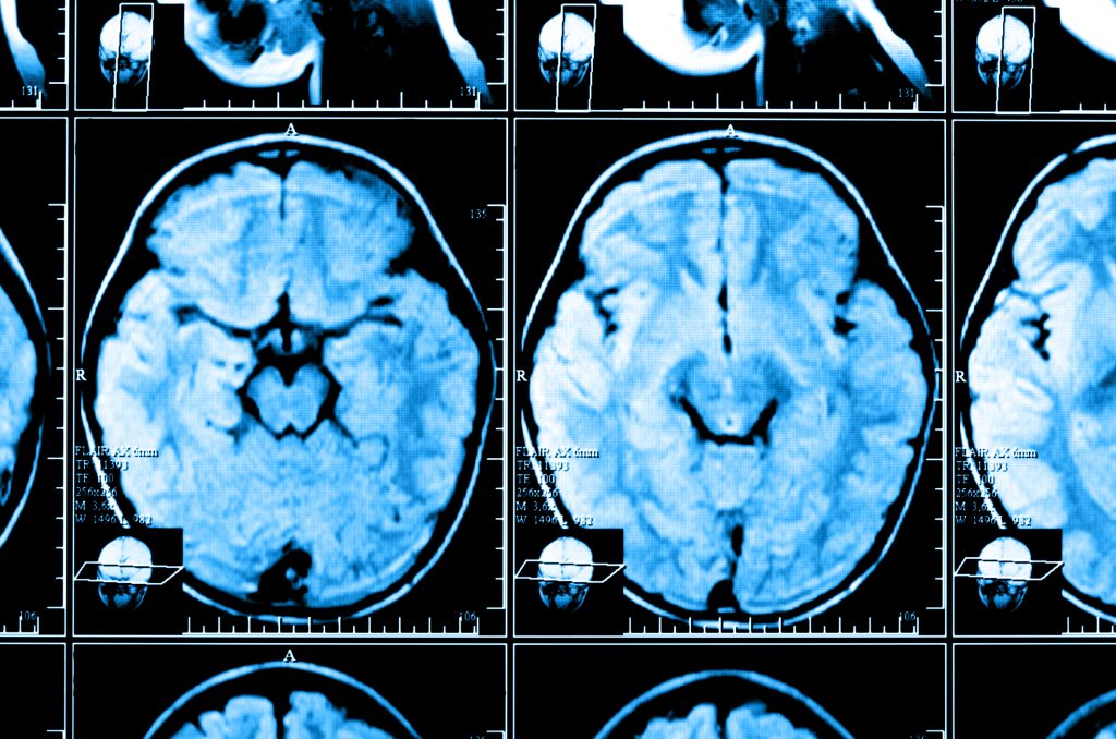 blunt force trauma tbi